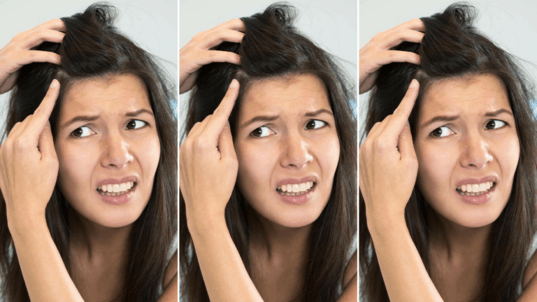 10 Easy Ways to Fix Your Dandruff Crisis